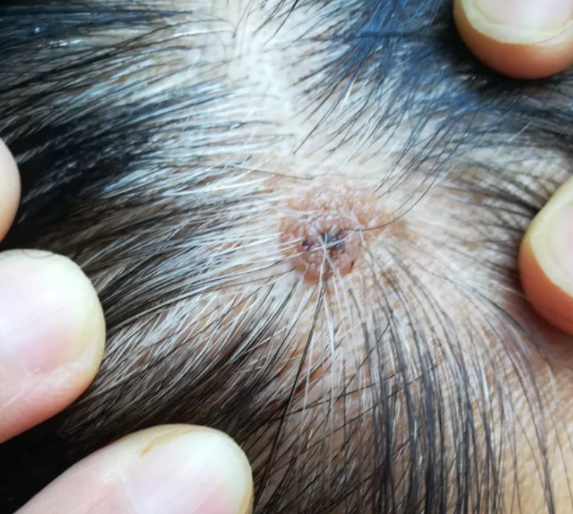 头皮上总"长痘痘",抠破还疼?暴露出3大"问题",一定要重视