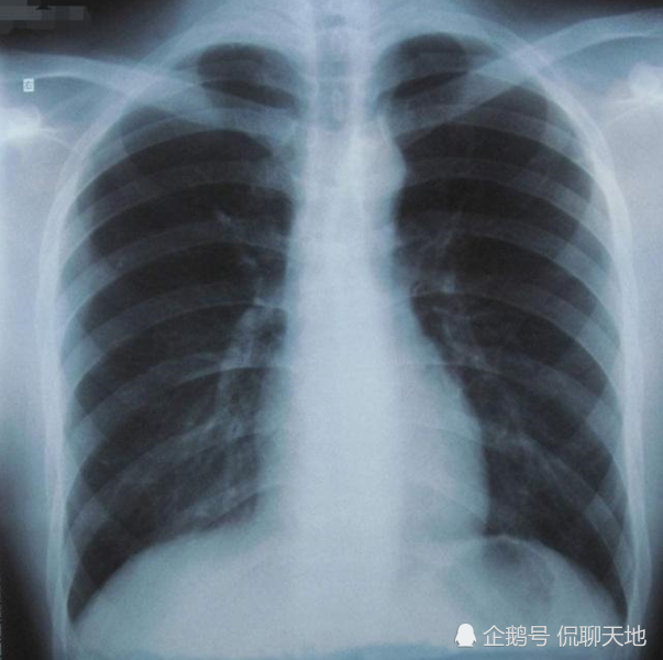 拍胸片要脱内衣吗图片_拍胸片对宝宝有影响吗