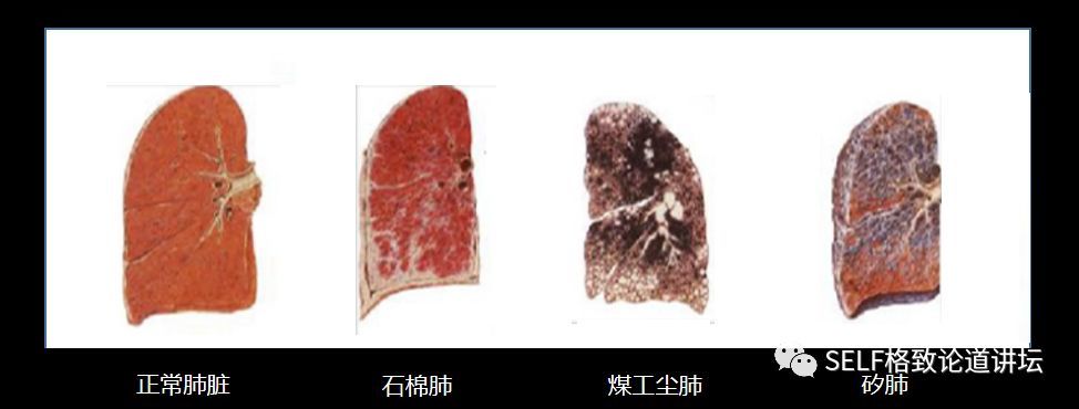 像石棉肺,煤工尘肺和矽肺都是比较常见的尘肺病的分类,这里面不同的