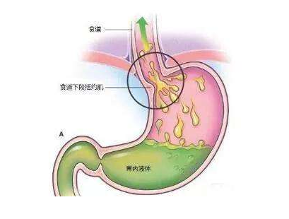 胆汁反流性胃炎的危害有哪些?