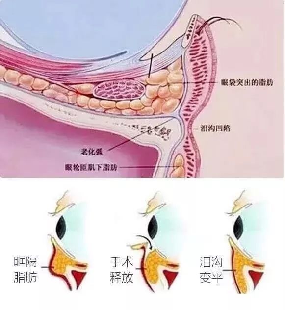 泪沟一出老十岁,如何改善的方法全在这里!