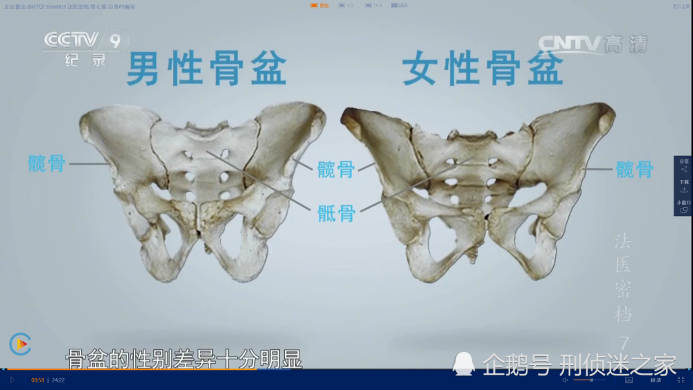 骨盆的性别差异十分明显,男性骨盆整体粗壮,骨骼厚重,入口形状近似于