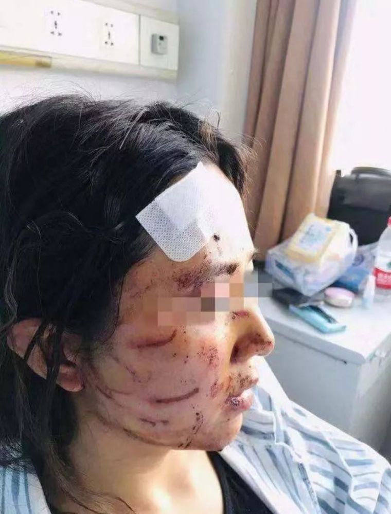 轻微伤,就是治安管理处理.