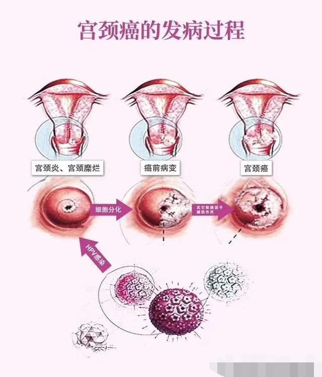 女人的哪些行为容易招来宫颈癌?尤其是第一个,再不知道就晚了