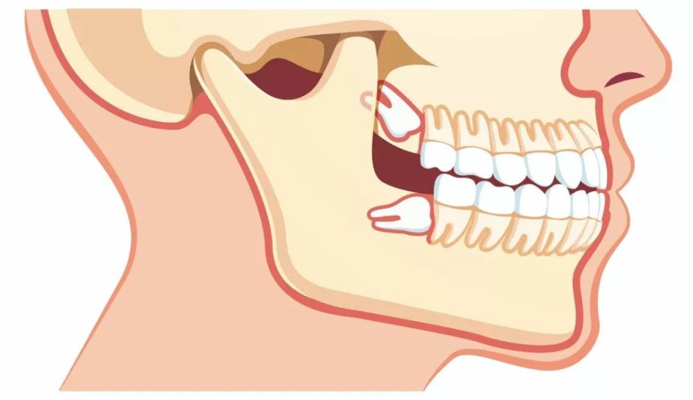 为啥有的人饱受智齿折磨有的人却压根不长答案都在这儿