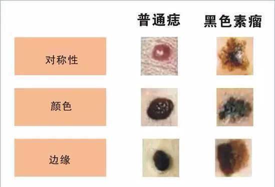 2看痣的边缘:普通痣边缘光滑,与周围皮肤分界清楚,而恶性黑色素瘤多