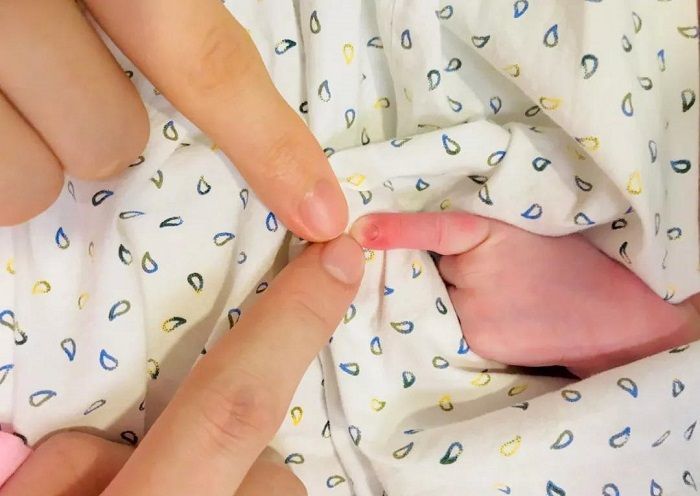 5个月婴儿紧握拳头,奶奶发现不正常,去医院检查后全家
