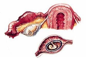 人工流产者 近年来,宫外孕的发生率增加了4～6倍,这主要与现代女性不