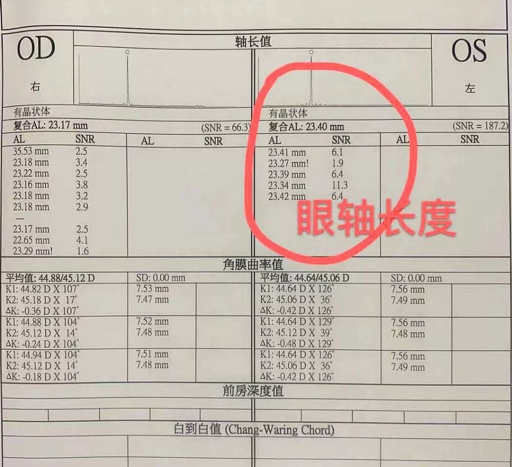 眼轴增长1mm,近视增加约300度,家长朋友们请注意