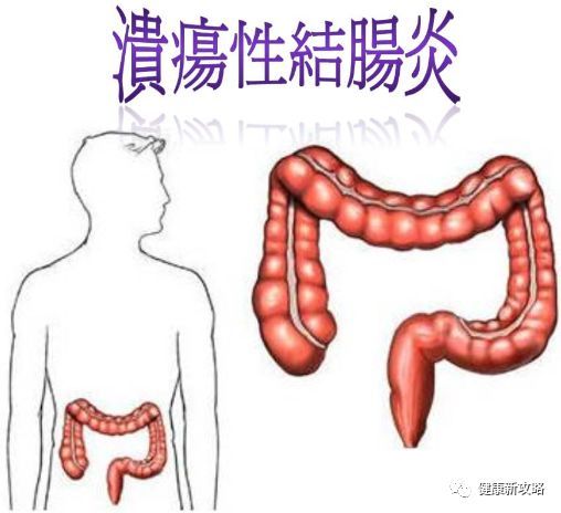 大便带黏液,血丝,伴左下腹痛3年,溃疡性结肠炎怎么治?