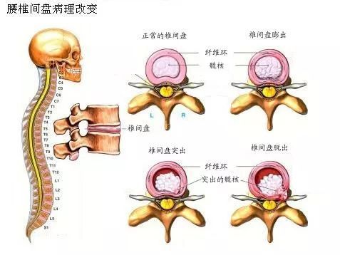 腰椎间盘突出"的过程 就相当于 轮胎漏气磨损的过程 主要分为 4步(期