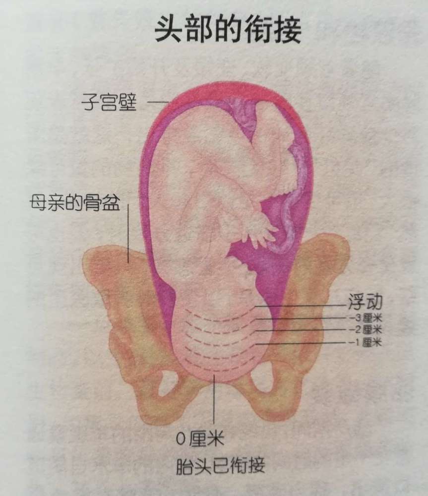 所谓入盆,就是孕晚期,随着子宫下段变软和扩张,胎儿在羊水和胎膜的