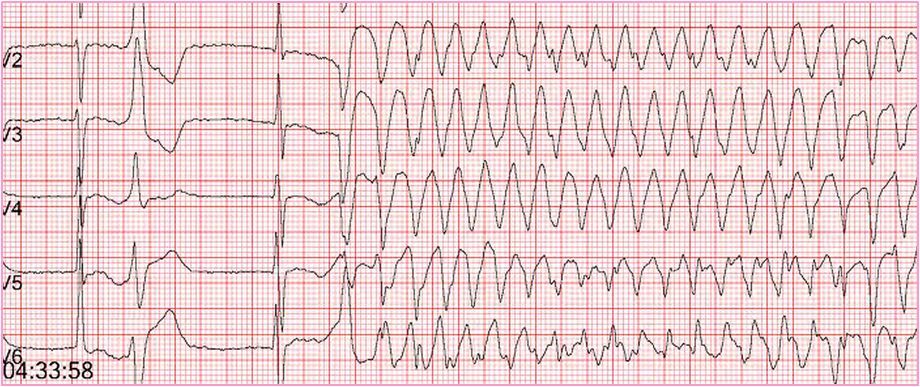 刘启明:心电图危急值(2)——恶性快速型心律失常的识别与处理