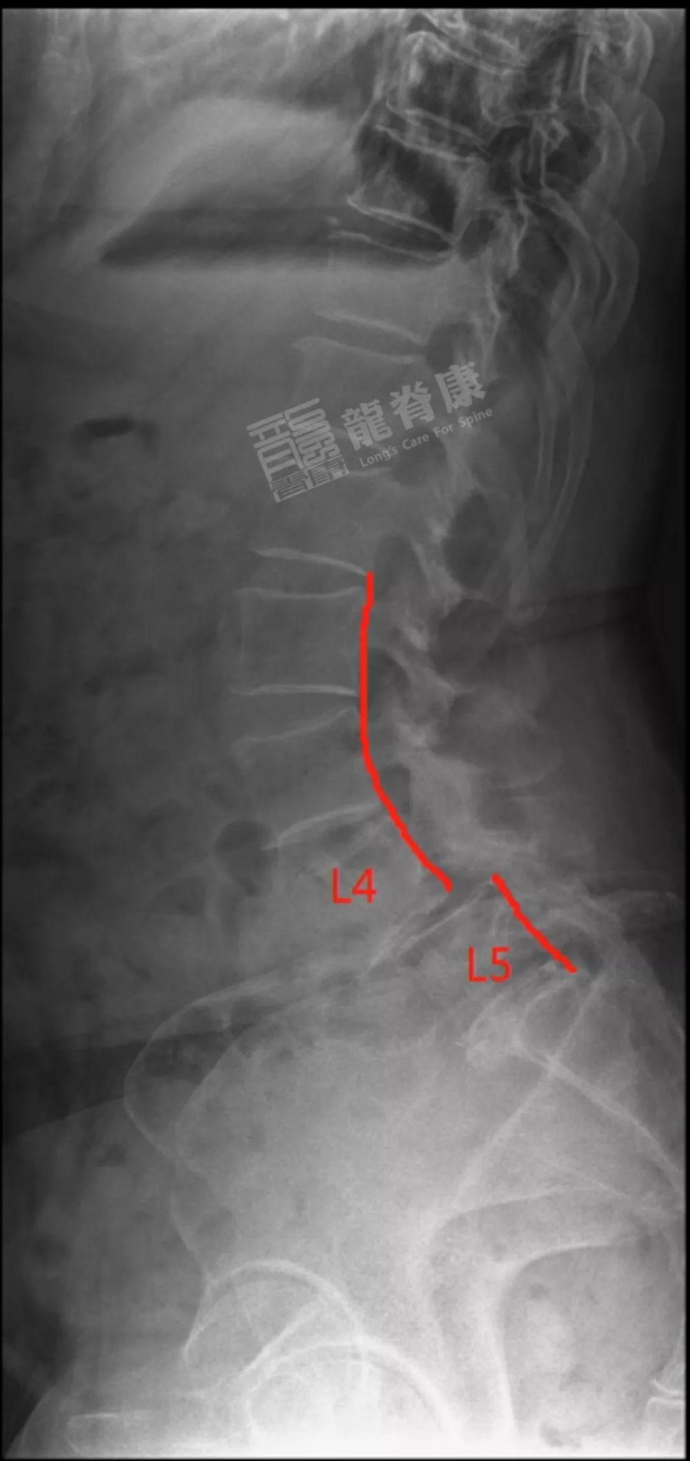 三,鉴别诊断 (1)与真性滑脱进行鉴别,真性滑脱呈现椎弓根峡部断裂,如