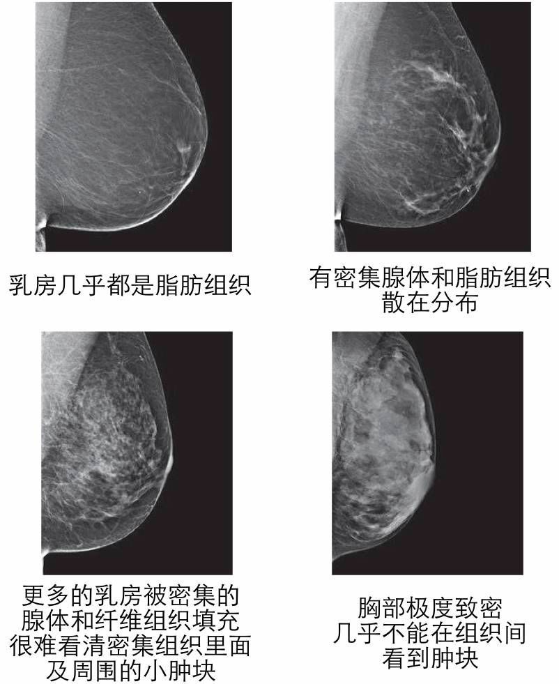 乳房 x 光片来确定.