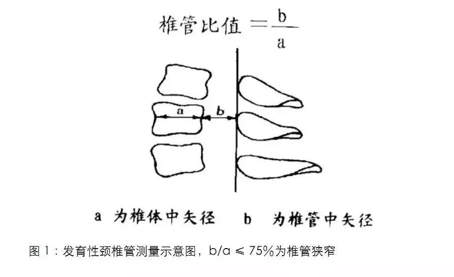 在颈椎侧位x线片上,c3到c6任何一个椎节,椎管的中矢状径与椎体的中矢