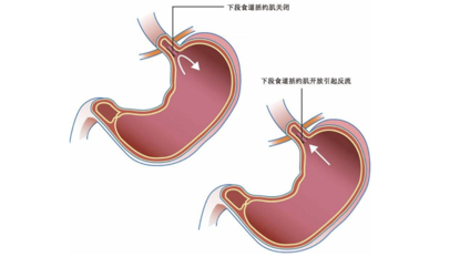 大致可分为两类: 01 原发性胃食管反流 原发性食管下括约肌关闭不全