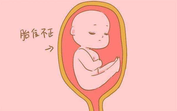 胎位不正不需要放弃顺产了 医生操作"外倒转"来帮忙