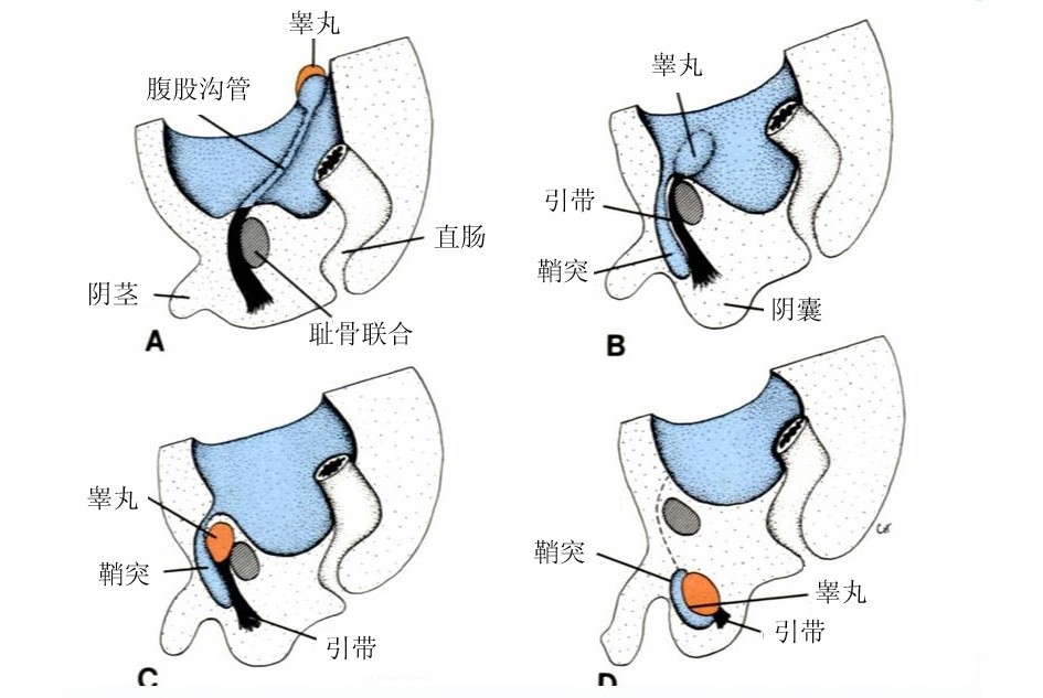 隐睾导致不育,治病需趁早——它引发的症状还有这些