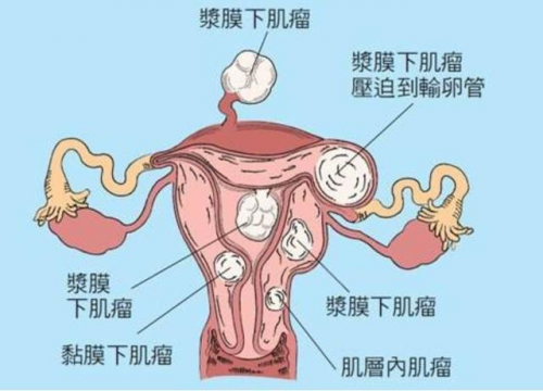 患上子宫肌瘤会不会癌变?需要切除吗?别困惑,看看医生怎么说!