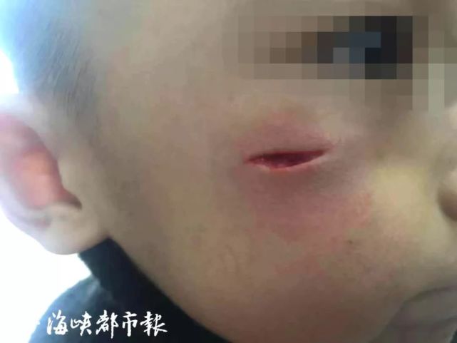 孩子在幼儿园中脸部受伤 裂开一个1.