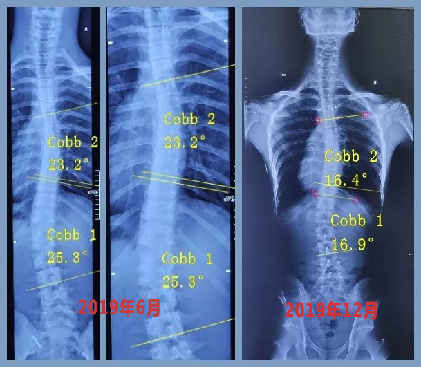 是典型的"s"型胸腰双弯,测量cobb角:胸弯23°;腰弯25°.