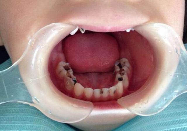 可见儿童龋齿是时下一个非常严重的现象.