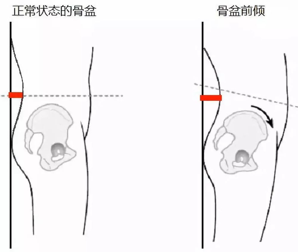 为了凸显翘臀,一直错误的维持骨盆前倾的位置,造成骨盆位置不正; 3.