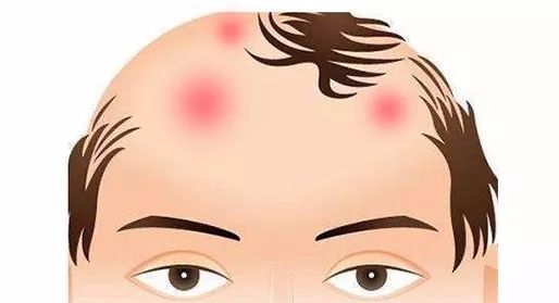 毛囊炎的5大类型,症状各不相同,一定要提高警惕