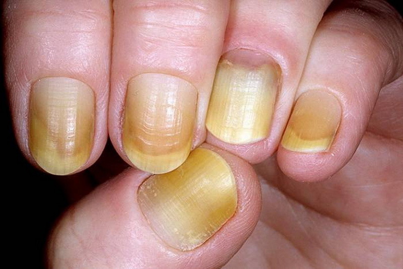 3. 黄色的指甲:真菌感染
