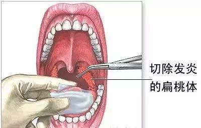 单纯的腭扁桃体发炎不会对颜值造成影响,多为发炎肿胀而导致喉咙疼痛