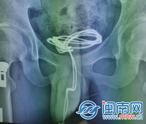 第909医院泌尿外科医师陈家财介绍,尿道及膀胱异物男性占大多数,且多