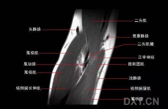 它位于腕关节的尺侧,包括腕关节尺侧伸肌腱鞘,桡尺背侧韧带,三角纤维