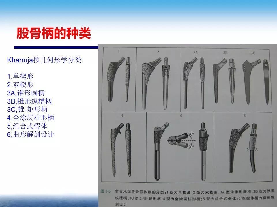 人工髋关节置换的假体选择