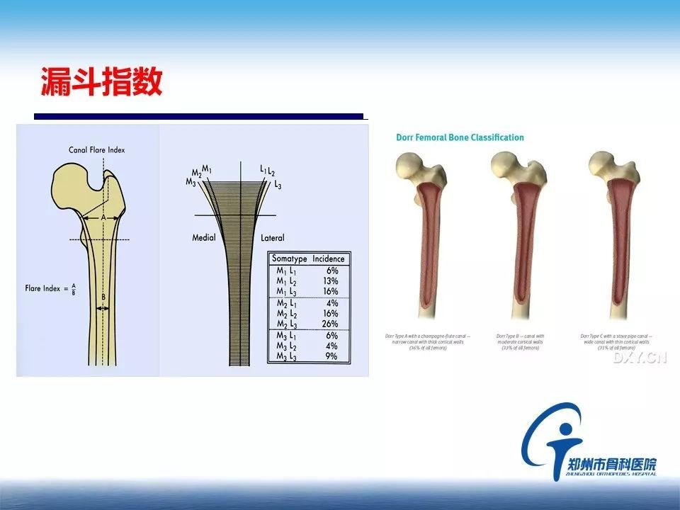 人工髋关节置换的假体选择