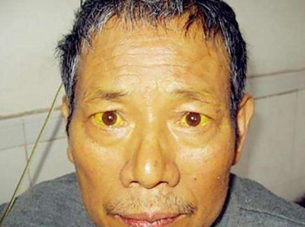 人黄是什么原因 腾讯网