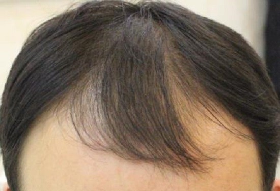 头皮出油厉害,头发少,掉发严重,都快看到头皮了