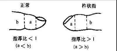 这是因为肺癌患者的指甲底部会微微隆起,这就是我们所说的杵状指.