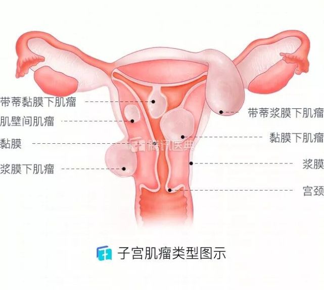 子宫容易长肌瘤的女人,都有这1个共性!发现异常别大意!