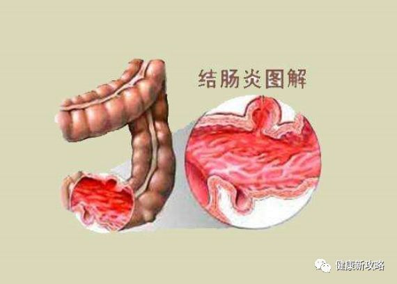 反复腹泻10年余,大便5～6次/d,呈稀糊状,夹有黏冻,伴腹痛肠鸣,头晕