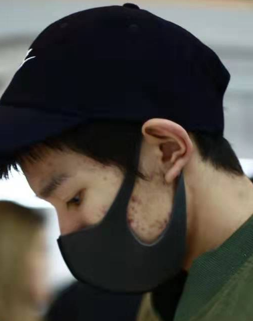 王源脸部痤疮严重被嘲"烂脸"?近镜头下一言难尽:你才19岁啊