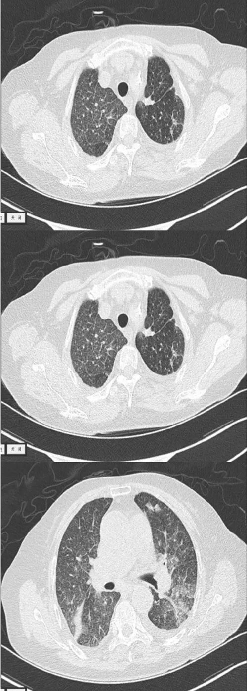 患者的肺部ct表现