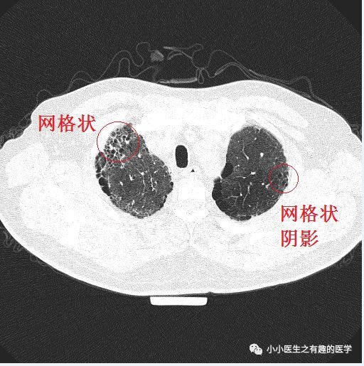 间质性肺炎的典型图谱,值得学习!