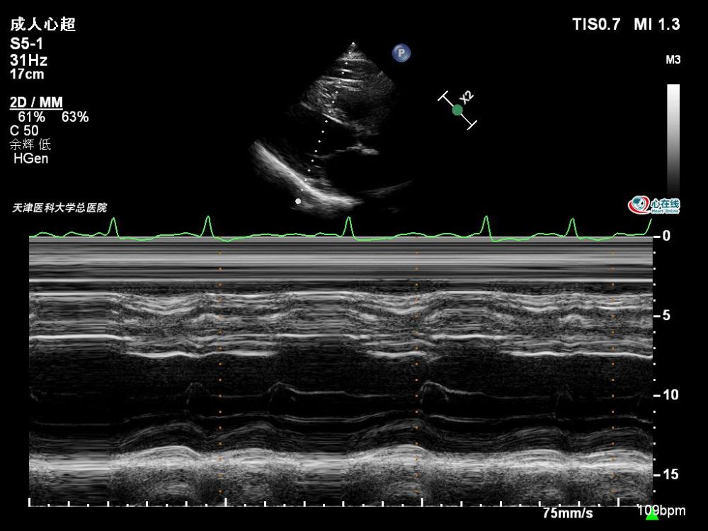 左心室m型超声运动曲线显示,左心室增大,右心室大小正常,室间隔及左