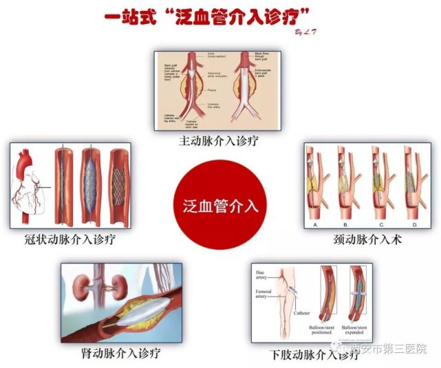 经上肢动脉"一站式泛血管介入诊疗" 让心血管介入体验