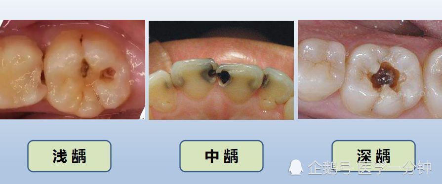 什么是龋齿,如何预防,需要拔牙吗?