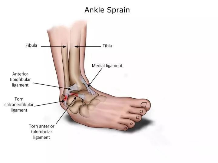 通常按韧带拉伤的程度不同,踝关节扭伤可分成三级