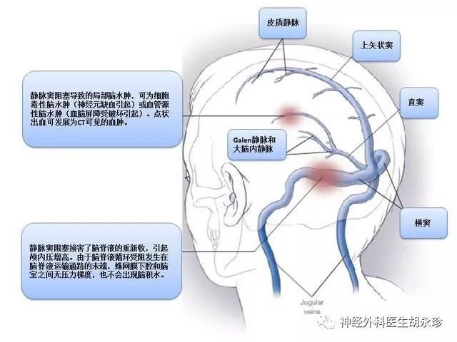 新生儿颅内静脉窦血栓形成