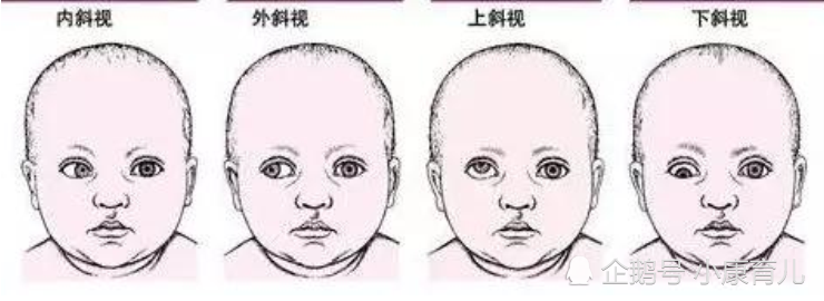 家长发现宝宝"斗鸡眼",害怕对智力有影响?听听专家怎么说