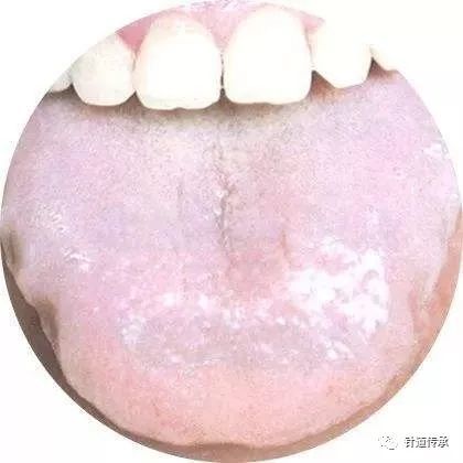 主病及相关研究: 前者淡白舌为气血两虚,其舌体大小正常或略小,气虚